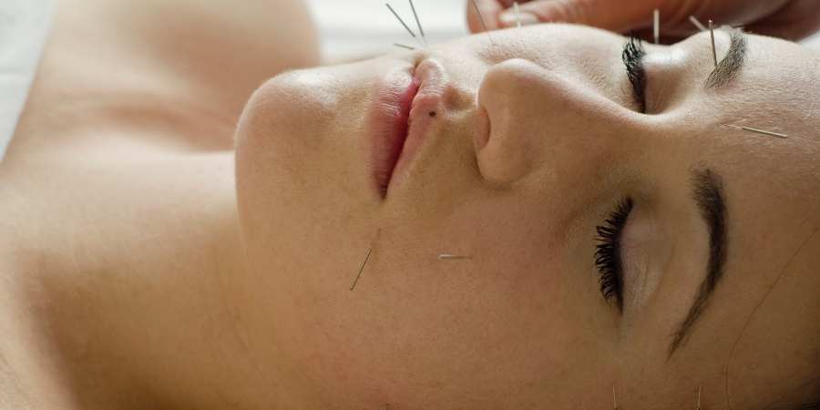 acupuntura para las arrugas